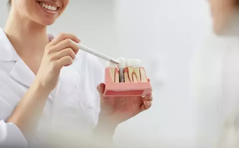 Dental Implants: How Long They Last