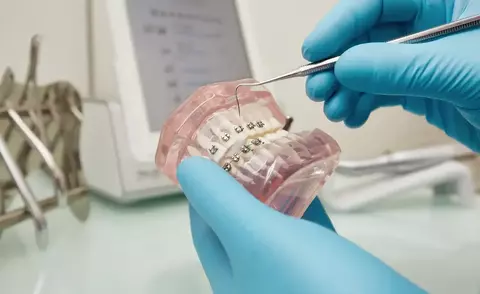 Orthodontics for Adults: Never Too Late