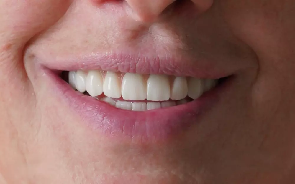 All-on-6 total rehabilitation with zirconium crowns — After