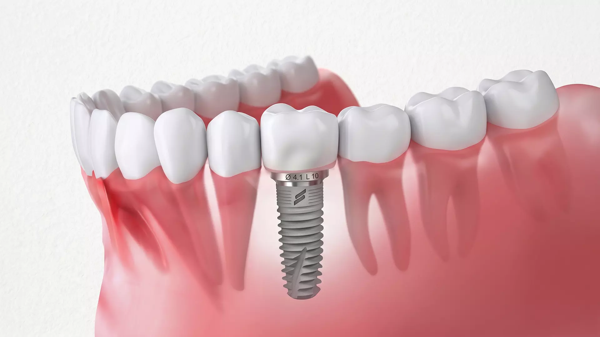 Impianti Dentali in Albania: Guida Completa