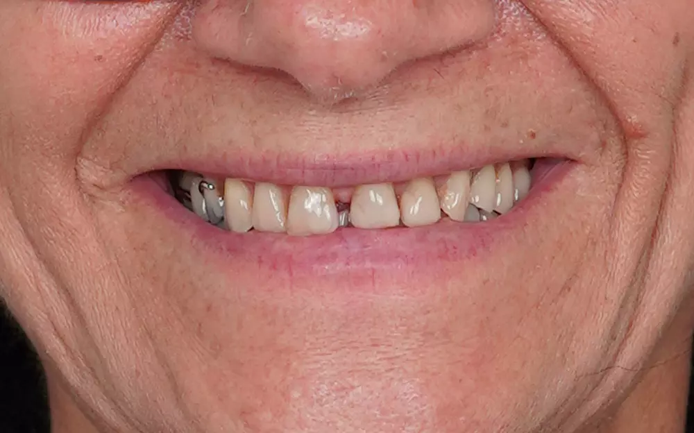 Zirconium crowns
