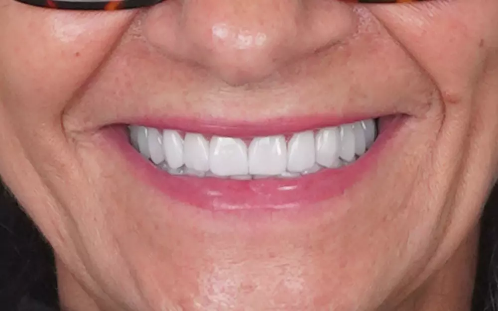 Zirconium crowns on natural teeth and implants — After