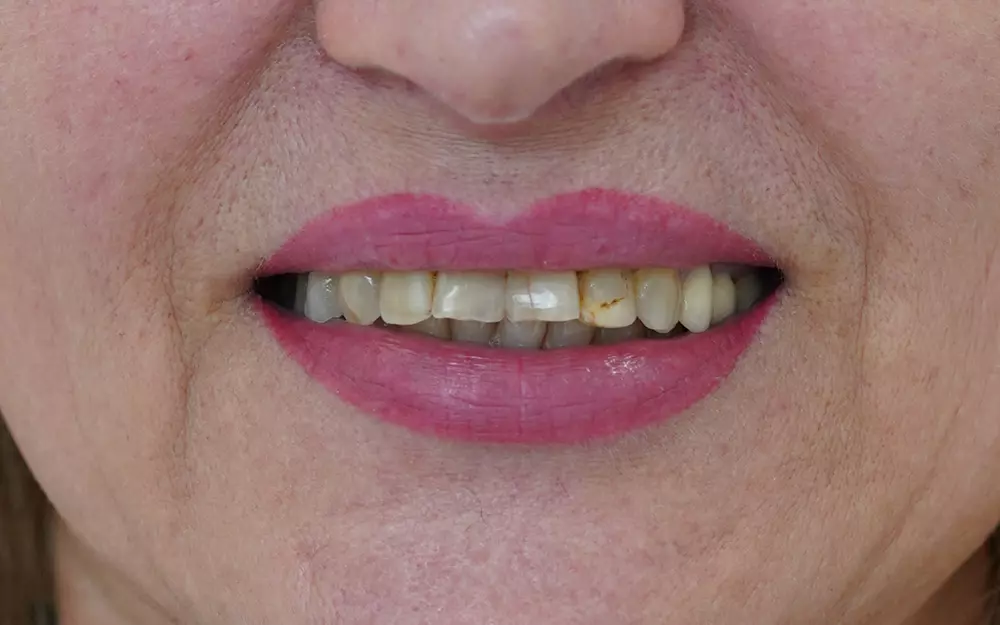 Zirconium-ceramic crowns on natural teeth and implants — Before