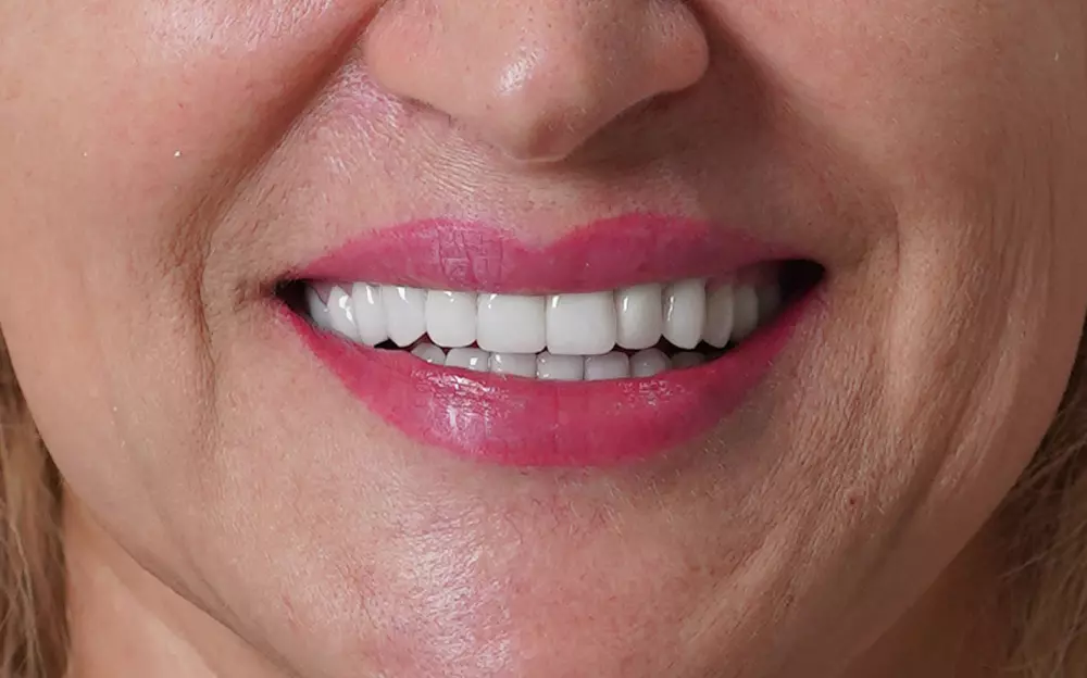 Zirconium-ceramic crowns on natural teeth and implants — After