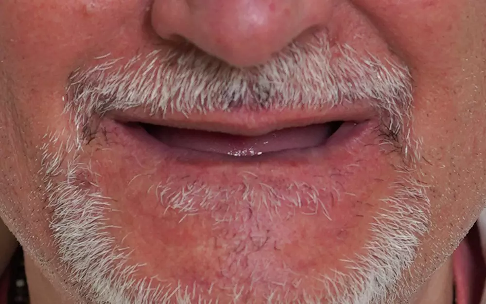 All-on-6 total rehabilitation with zirconium crowns — Before