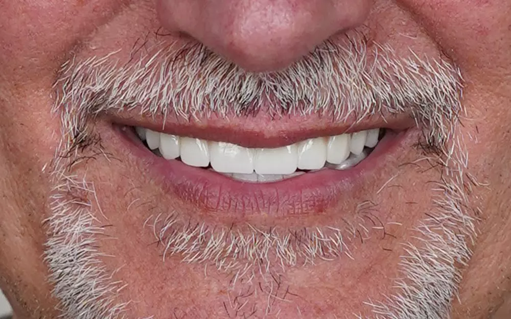 All-on-6 total rehabilitation with zirconium crowns — After