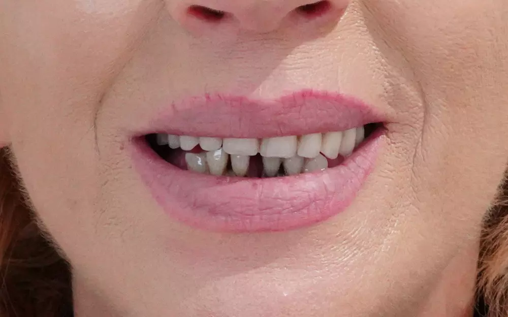 All-on-6 total rehabilitation with zygomatic and pterygoid implants and zirconium crowns — Before