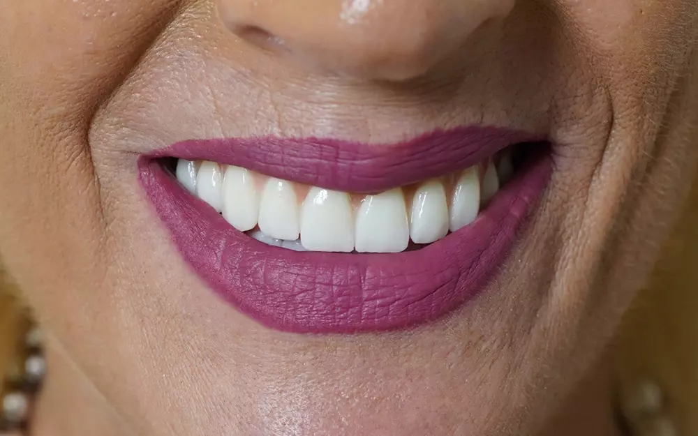 All-on-6 total rehabilitation with zygomatic and pterygoid implants and zirconium crowns — After
