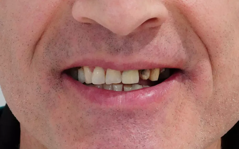 Zirconium crowns on natural teeth and implants — Before