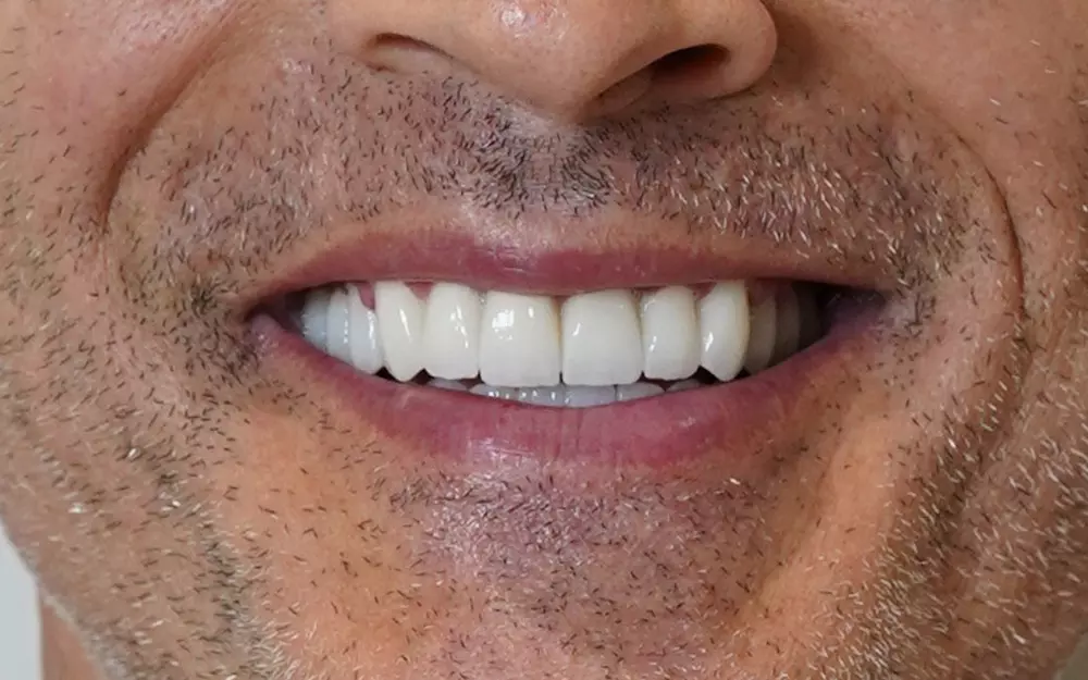 Zirconium crowns on natural teeth and implants — After