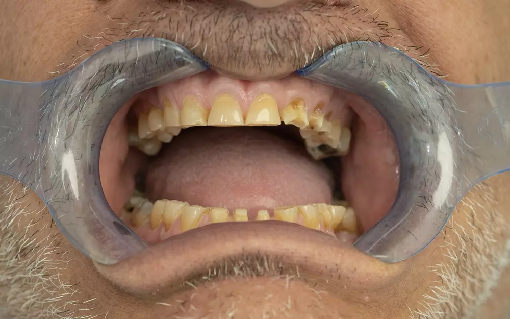 Zirconium crowns on natural teeth — Before