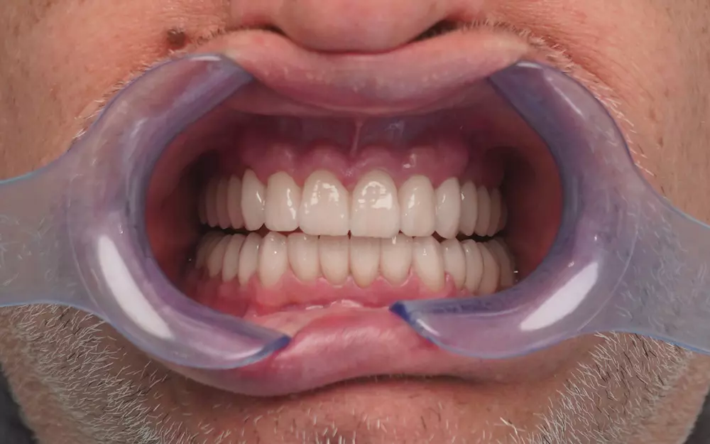 Zirconium crowns on natural teeth — After