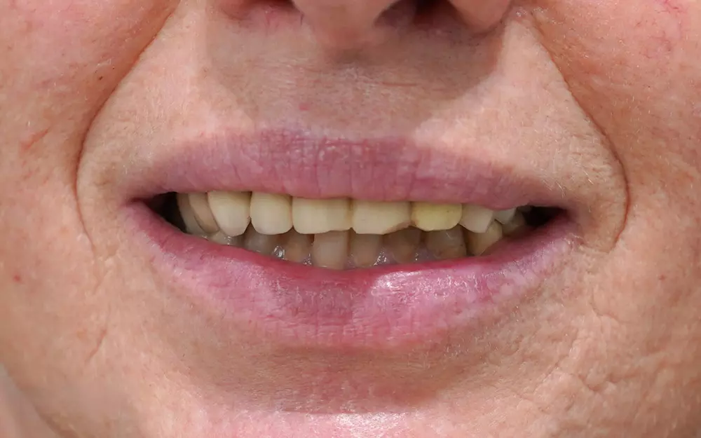 All-on-6 total rehabilitation with zirconium crowns — Before