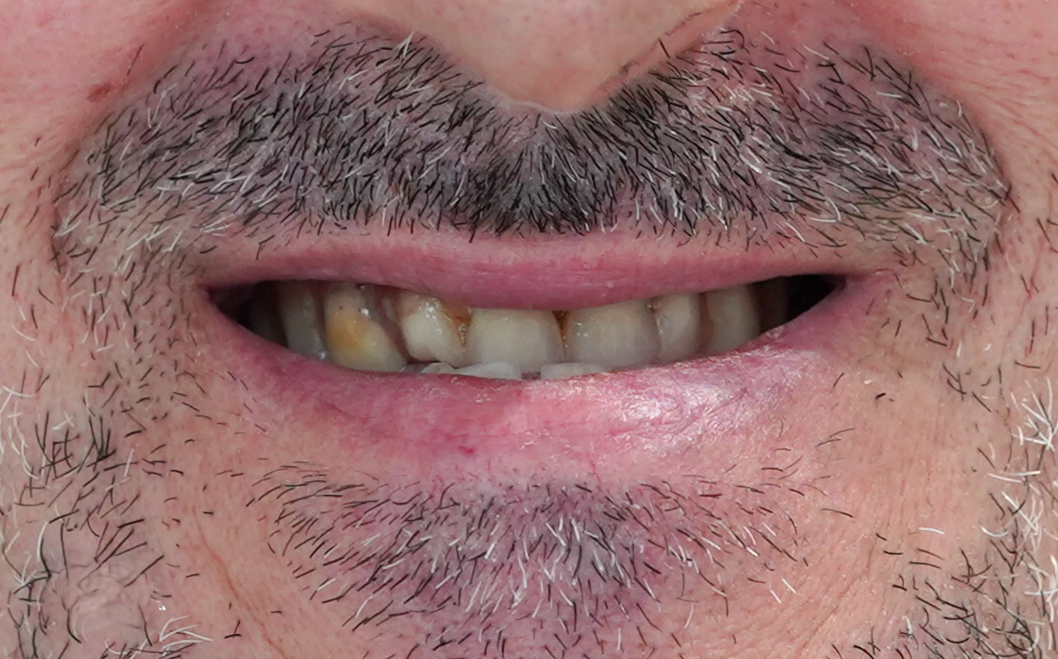 All-on-6 total rehabilitation with zirconium crowns — Before