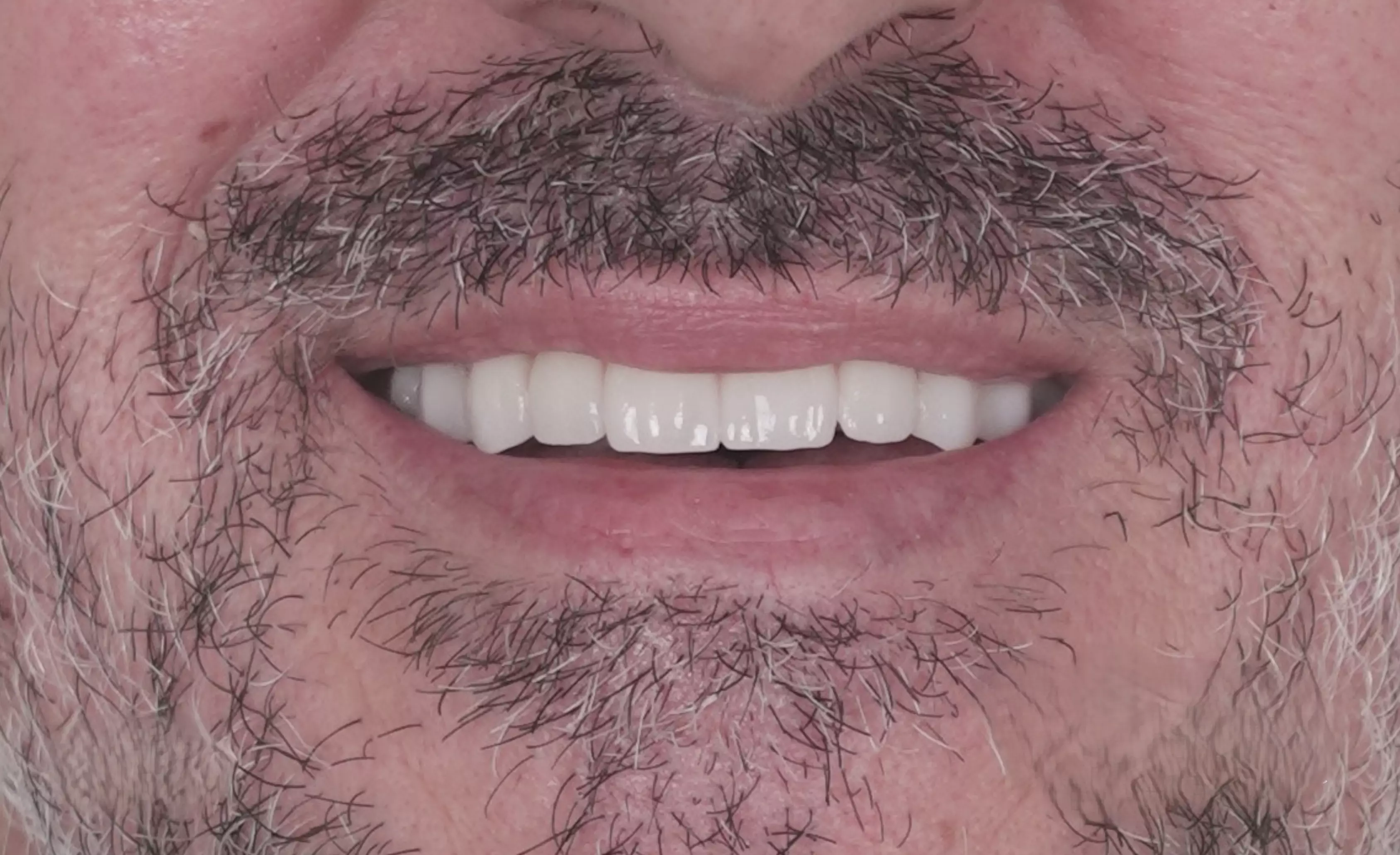 All-on-6 total rehabilitation with zirconium crowns — After