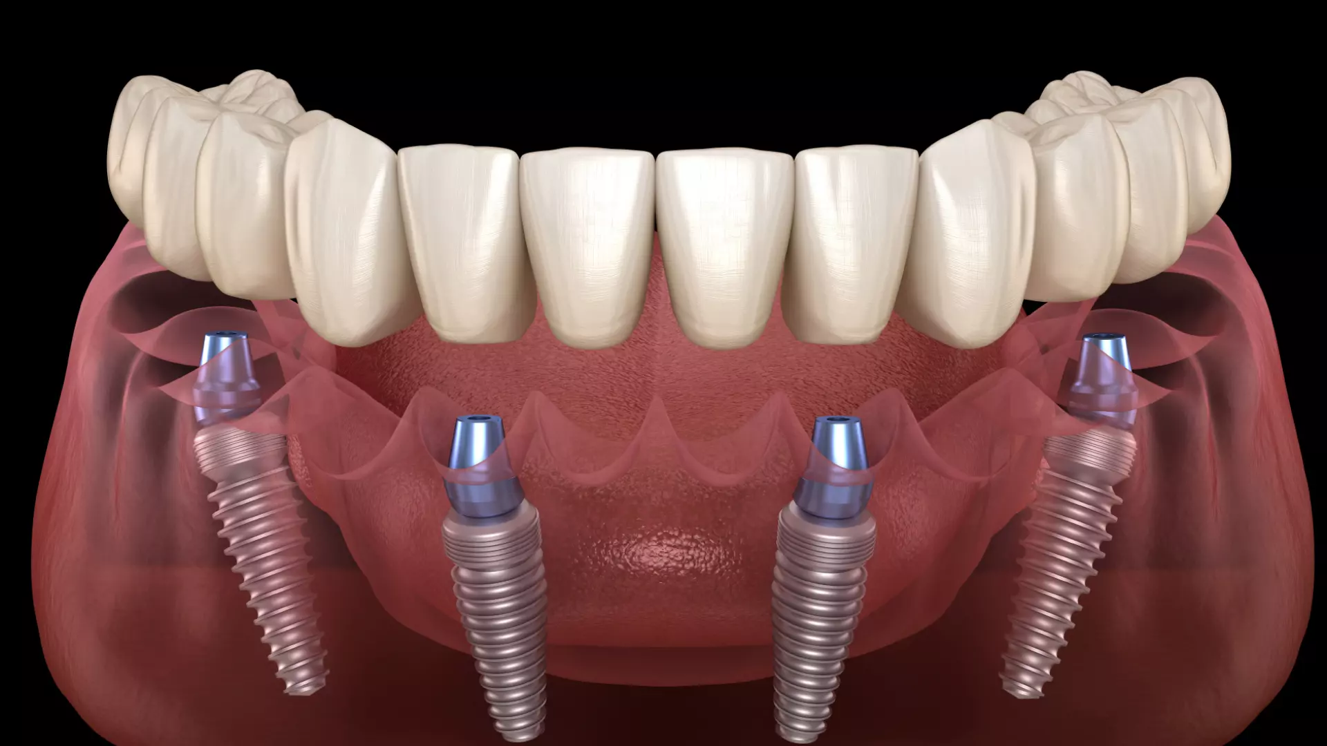 All-on-4 Dental Implants in Albania: The Complete Treatment Guide (2026)