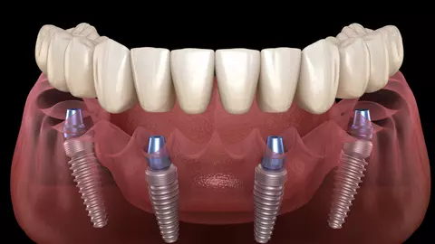 All-on-4 Dental Implants in Albania: The Complete Treatment Guide (2026)