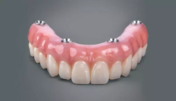 All-on-4 Recovery: What to Expect Week by Week (2026)