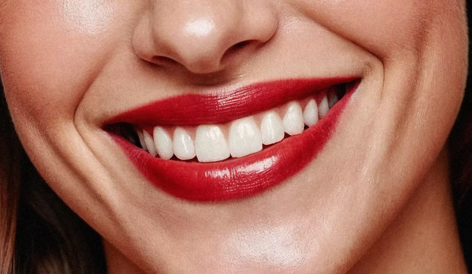 Hollywood Smile Aftercare: Care and How Long It Lasts (2026)