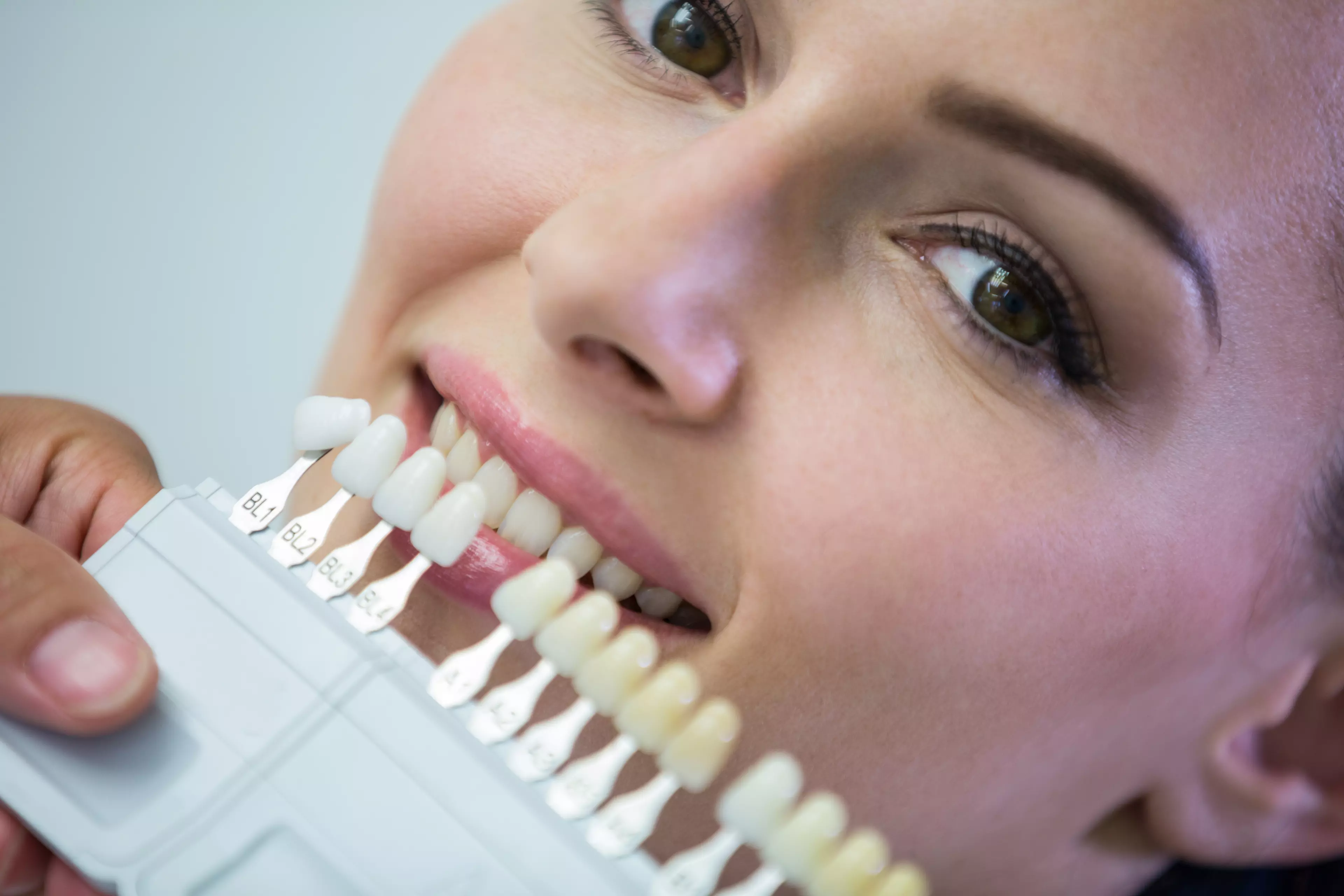 How Long Do Veneers Last? Aftercare and Lifespan (2026)