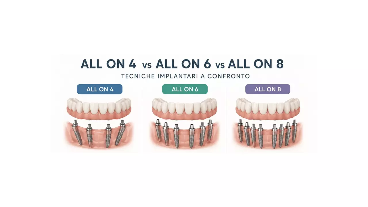 All-on-4, All-on-6 o All-on-8: Differenze e Come Scegliere